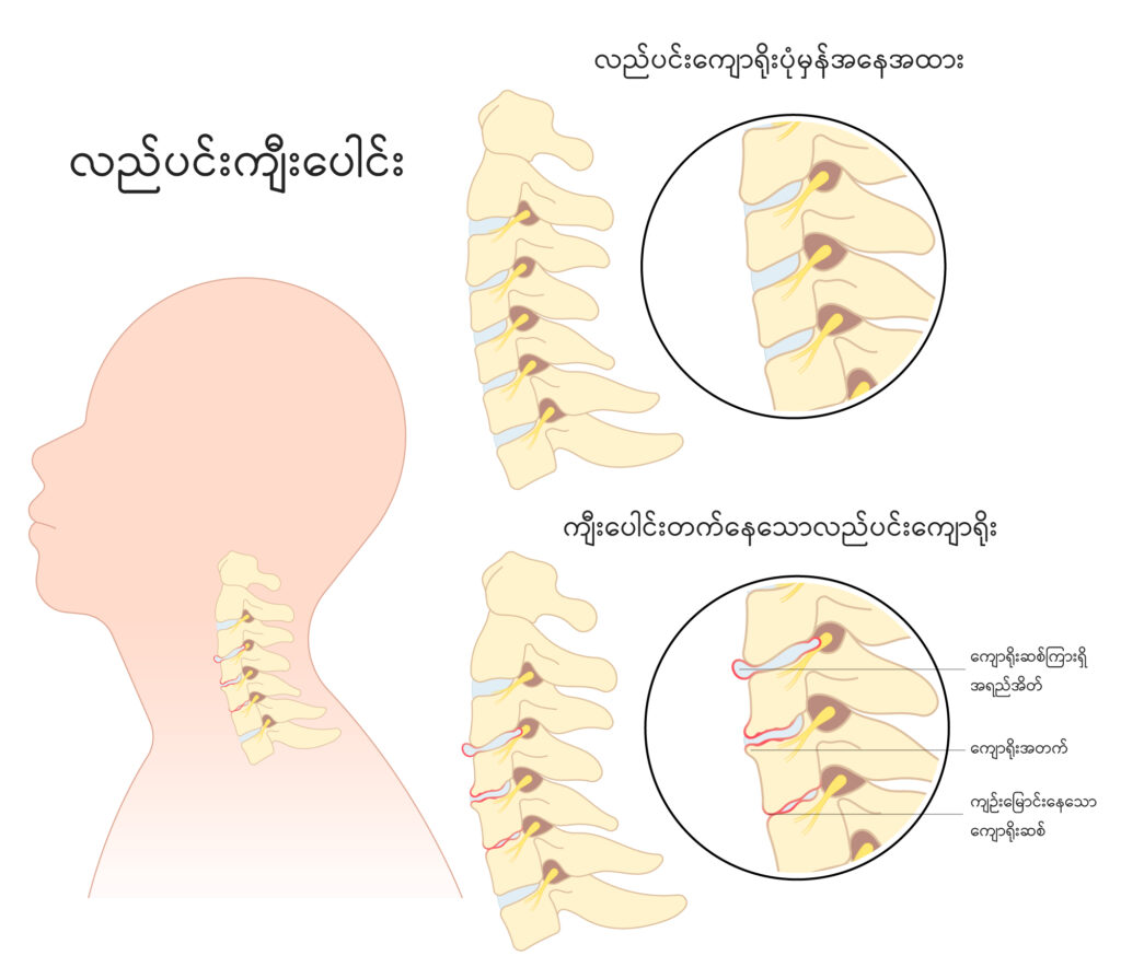 Cervical Spondylosis Image 2