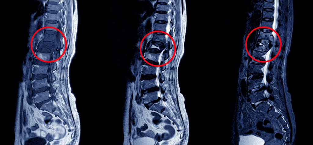 Spinal Tuberculosis Image 2