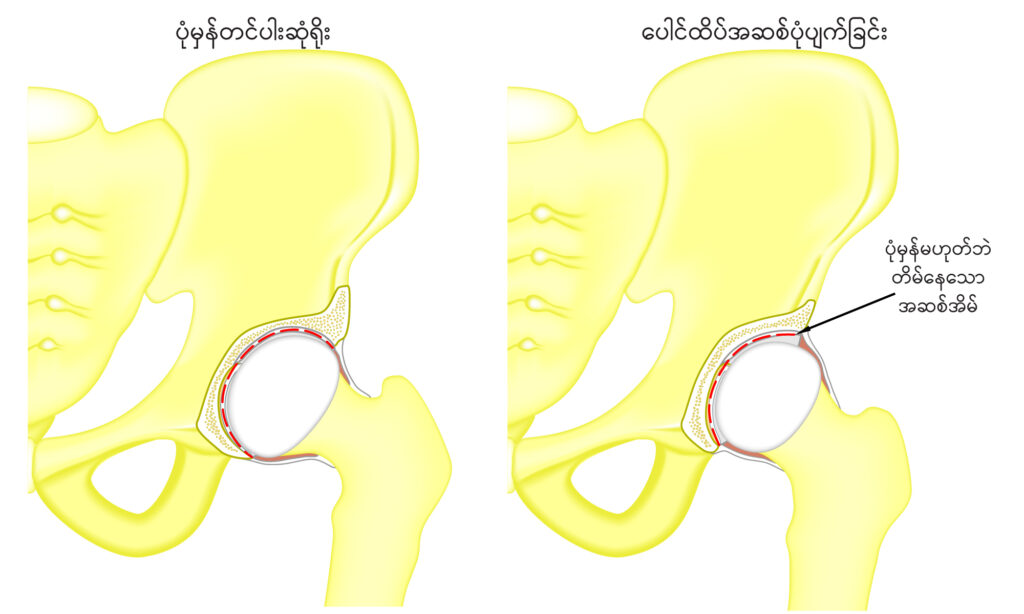 Developmental Dysplasia of Hips Image 1