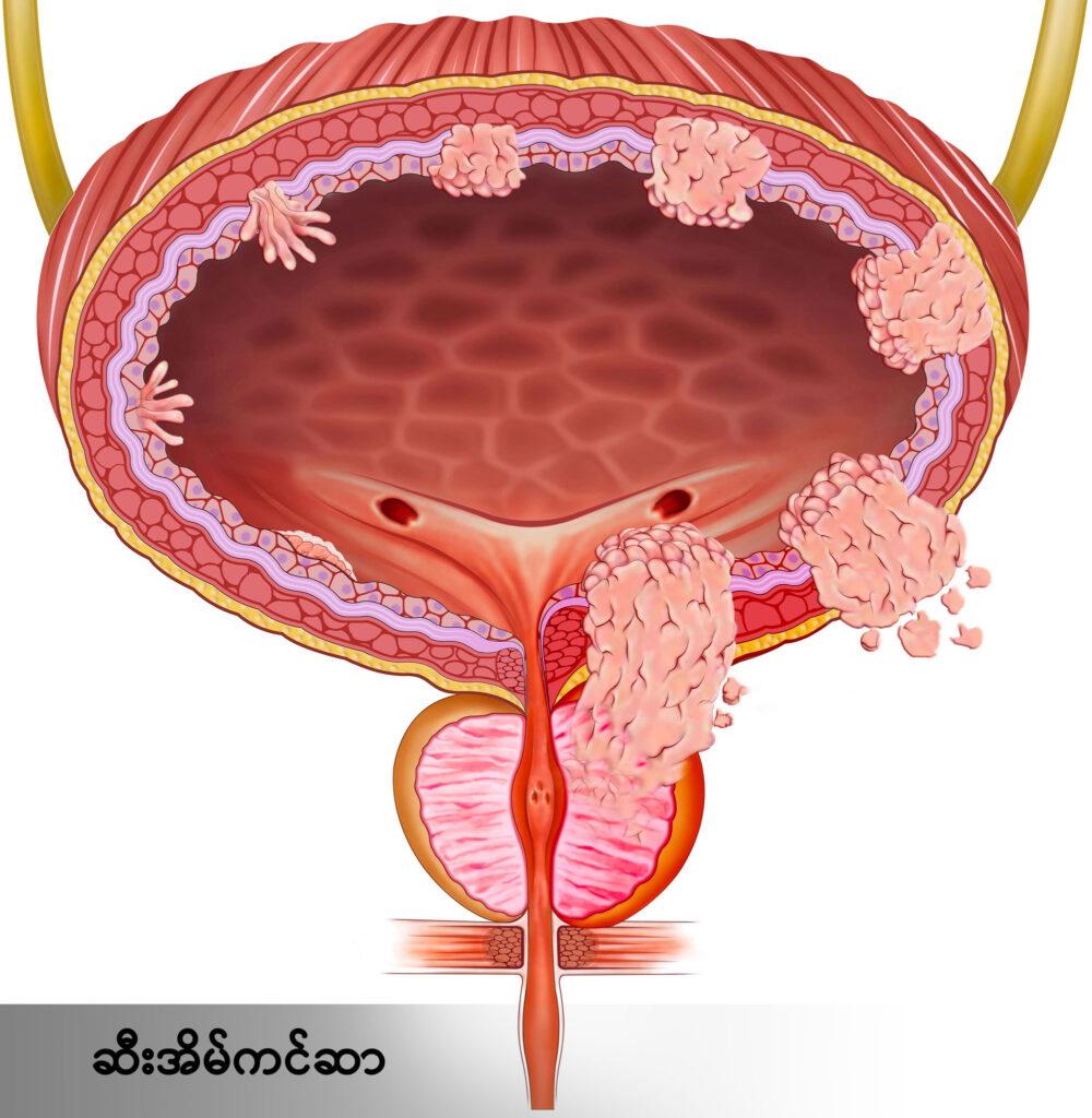 Bladder cancer image 1