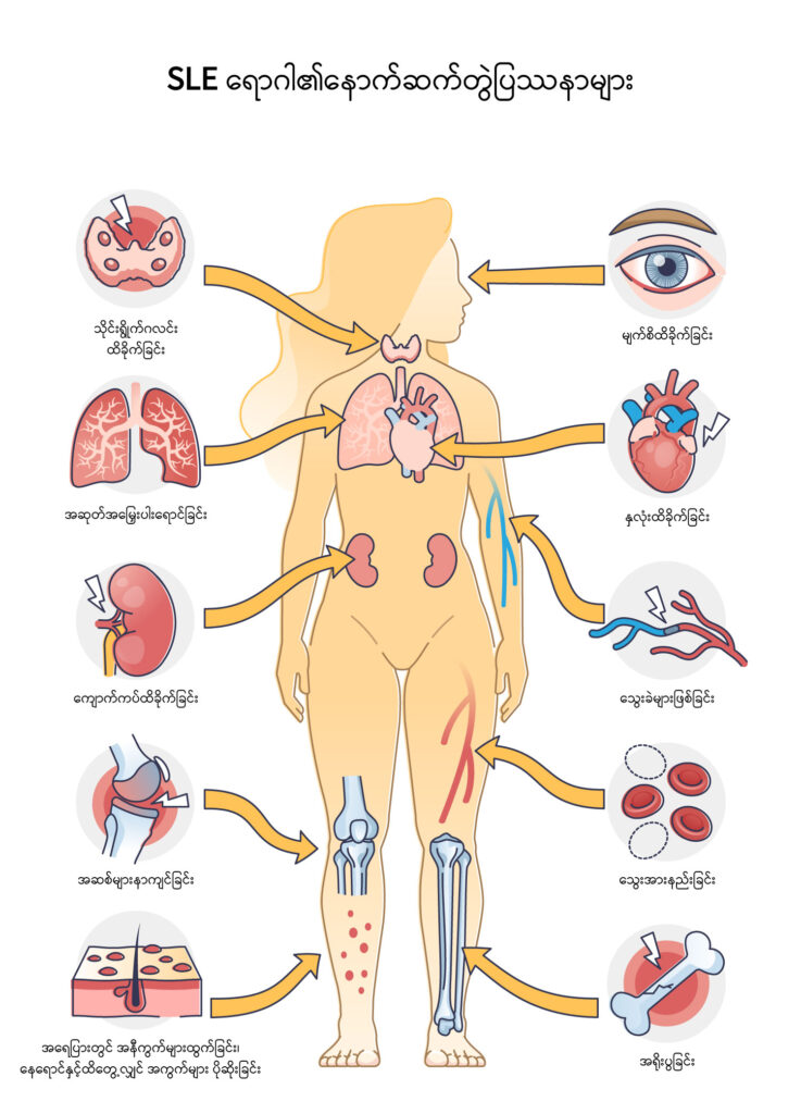 Systemic lupus erythematosus image1