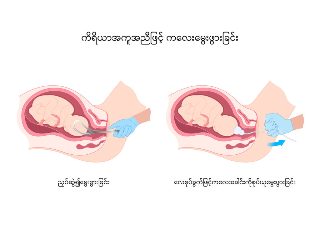 Assisted vaginal delivery image1