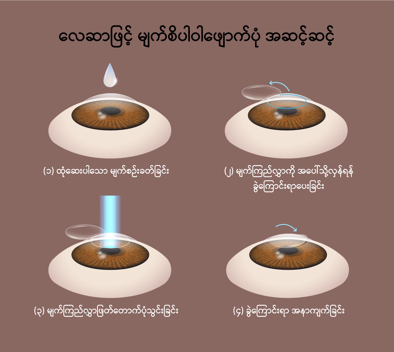 Refractive surgery image