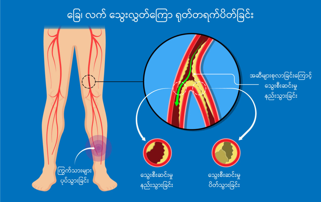 Acute Limb Ischemia image