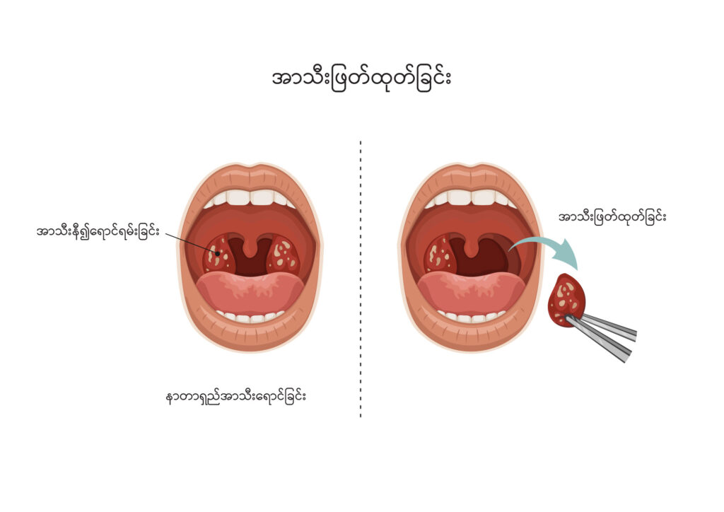 Tonsillectomy image